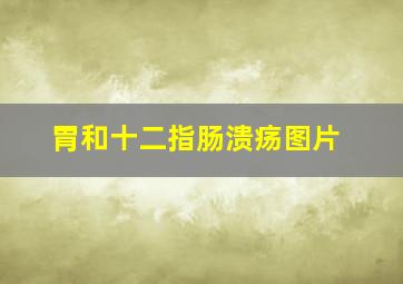 胃和十二指肠溃疡图片